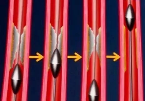 康美梅河口中心医院成功完成吉林省东南部首例