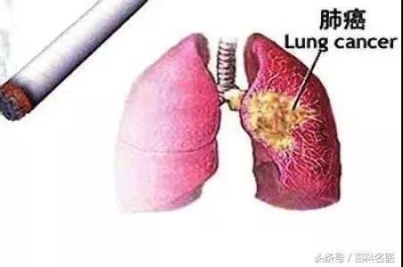 吸烟和肺癌的关系