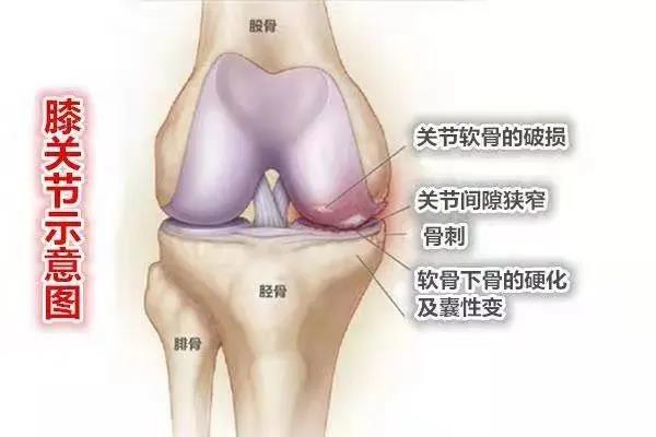 膝关节骨性关节炎的预防与治疗