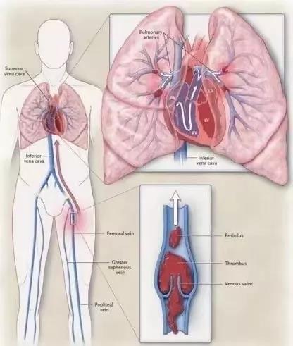 肺动脉栓塞是什么？